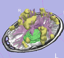 The preoperative imaging shown here contains information essential to the surgeon (including the tumor, visible in green); but it cannot be used during the operation, unless it is updated to account for the tumor's shifting location.
