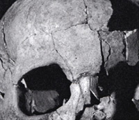 This skull of a 15-to 20-year-old male was excavated from the African Burial Grounds. It reveals diseases indicative of nutritional stress, according to researchers.